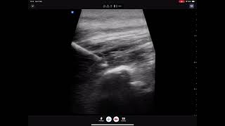 ESP block at T5 for intercostal neuralgia [upl. by Bennett86]