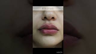 Lip Filler Before and After Compilation  LIP FILLER drjyotiguptadermatologist7266 Lip Injections [upl. by Goodson108]