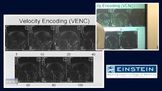 Introducing MRI Phase Contrast MRA 45 of 56 [upl. by Noraf]