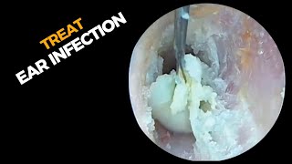 The LittleKnown Truth About Earwax and a Runny Nose Are You Ready to Discover It DeepEarWaxing [upl. by Rehotsirhc]