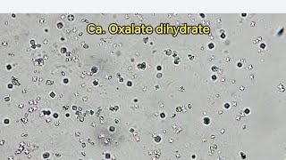 calcium oxalate dihydrate in urine sample GUE urinalysis urinalysis فحص الادرار [upl. by Kovar]