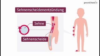 Was ist eine Sehnenscheidenentzündung [upl. by Florian717]