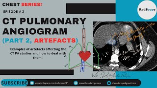 CT Pulmonary Angiogram Part 2 Artefacts [upl. by Ardnovahs]