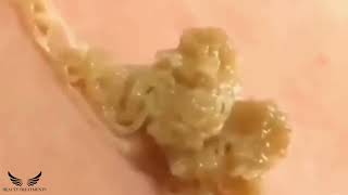 Severe Cystic Acne Blackheads Removal  Elderly Pimple Popping  Inflammatory Acne Extraction 034 [upl. by Yenitirb916]