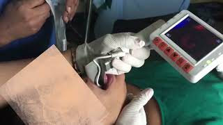 Intubation procedure [upl. by Kenimod790]