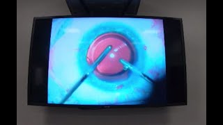 RLE eye surgery on HG pilot [upl. by Anaujit875]