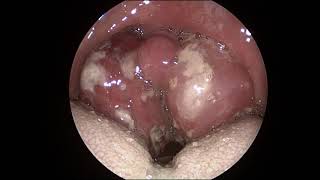 Acute Tonsillitis [upl. by Raul728]