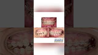 CORRECTION OF MIDLINE DEVIATION AND BOLTON DISCREPANCY  ORTHODONTIC TIPS Shorts [upl. by Yahiya]