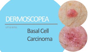 Dermoscopea Little Bites presents Basal Cell Carcinoma [upl. by Oigimer74]