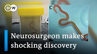 Neurosurgeon removes live worm from womans brain in worldfirst discovery  DW News [upl. by Burl340]