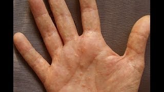 Dermatitis or Dyshidrosis How I Prevent Getting Painful And Unsightly Summer Hands [upl. by Grimaldi]