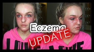 My Eczema Story UPDATE 2017 [upl. by Hluchy894]