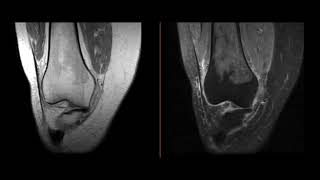 Red marrow conversion on MRI [upl. by Aihset]