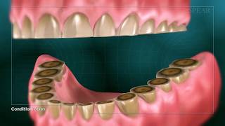 Teeth Grinding [upl. by Latsyrcal]