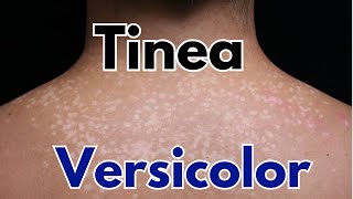 Tinea versicolor symptoms treatment  how to get rid of tinea versicolor [upl. by Mulcahy]