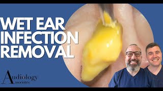 EAR INFECTION REMOVAL EP870 [upl. by Buddie]