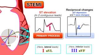 Ischemia 67  STEMI on ECG [upl. by Sirob]