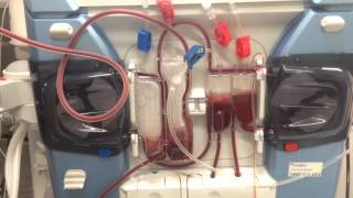 Single Needle Dialysis [upl. by Valentine]