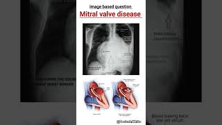 Mitral valve disease  xray finding  viralvideo mitralvalve xray medicine [upl. by Monie]