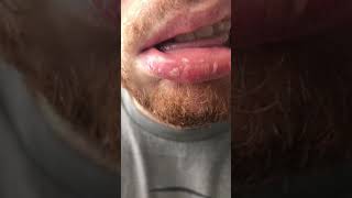 Exfoliative Cheilitis  Dovonex amp Elidel Treatment Results [upl. by Jori]