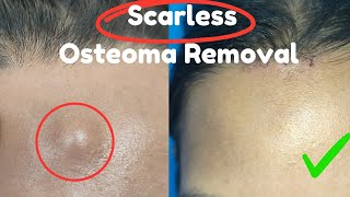 Scarless Osteoma Removal Bony swelling removal from forehead Best osteoma Removal [upl. by Carroll638]