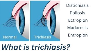 What is Trichiasis  eyelashes turning into eye  trichiasis in hindi  trichiasis eyelashes [upl. by Ursulina]