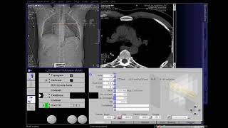 CT Coronary Angio Full Work Process SIEMENS in syngo acquisition workplace [upl. by Hilton]