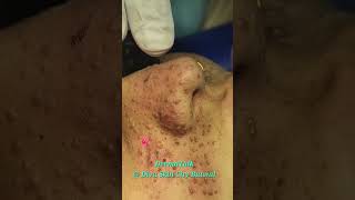 Facial Angiofibromas Removal with CO2 Laser [upl. by Sikata756]