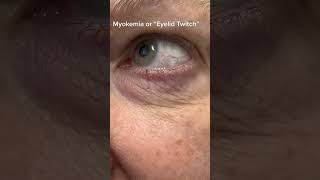 Eyelid TwitchingMyokemia eyes eyecheckup [upl. by Reniar]