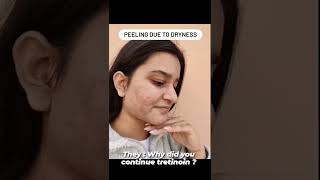 TRETINOIN BEFORE amp AFTER 5 months skincare shorts acne tretinoin explore hormonalacne [upl. by Selma]