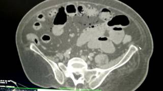 Air in small bowel wall pneumatosis intestinalis [upl. by Dorri]