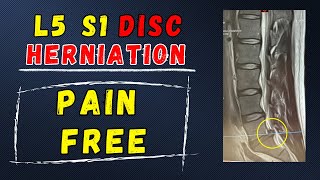 L5 S1 Disc Herniation Recovery without surgery [upl. by Adnavoj]