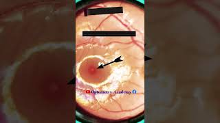 Normal fundus with foveal reflex present  Normal fundus  Normal Retina  Short Video 114 [upl. by Enyalahs]