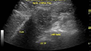 facet and iliolumbar ligament inj 腰椎小面關節和髂腰韌帶注射 [upl. by Zetnod]