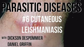 Parasitic Diseases Lectures 6 Cutaneous Leishmaniasis [upl. by Bain]