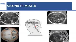 Fetal CNS Abnormalities  Dr C Verenga [upl. by Dorella]