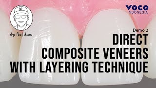 Direct Composite Veneers with 2 Layers Technique using AMARIS  Operative Dentistry  VOCO GmbH [upl. by Raquel]