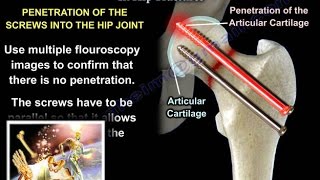 Complications In Hip Fractures  Everything You Need To Know  Dr Nabil Ebraheim [upl. by Ajup]