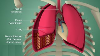 Pleural Effusion Explained Clearly  Causes Pathophysiology Symptoms Treatment [upl. by Anniram13]