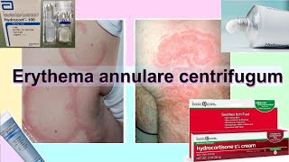 erythema annulare centrifugum [upl. by Annairam857]