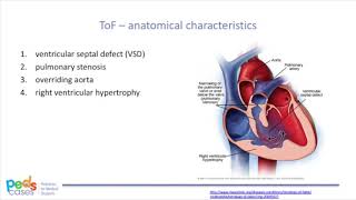 Tetralogy of Fallot [upl. by Naivart]