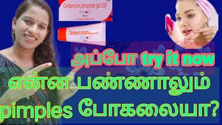 Pimple care tips ErytopHow to use Erytop in tamilside effectsErytop Review in tamil [upl. by Luigino]