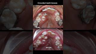 The most crowded teeth ive ever seen braces orthodontist dentist [upl. by Nygem]