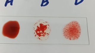 how to perform blood groupblood group ABO blood groupingB positive blood group [upl. by Gombosi602]