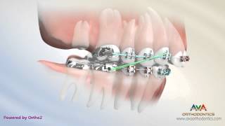 Orthodontic Treatment for Overbite Overjet  Removing Second Molar [upl. by Milicent]