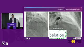 Go beyond metal exploring drugeluting balloon technology in de novo coronary lesions  EuroPCR [upl. by Cannon]