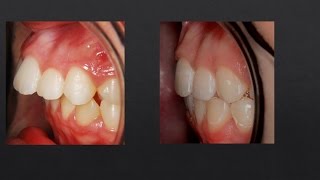 8mm Overjet Correction Orthodontics [upl. by Jariv]