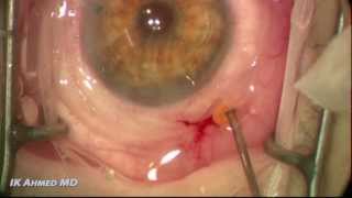 Nanophthalmos Pars Plana 23G vitrectomyiridozonulohyaloidectomy with highpower XTremeD lens [upl. by Elum]