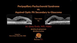 Peripapillary Pachychoroid Syndrome vs Aquired Optic Pit Secondary to Glaucoma [upl. by Rhines364]