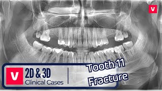 Vatech 2D amp 3D Clinical Cases 🩺 Tooth 11 Fracture [upl. by Blalock]